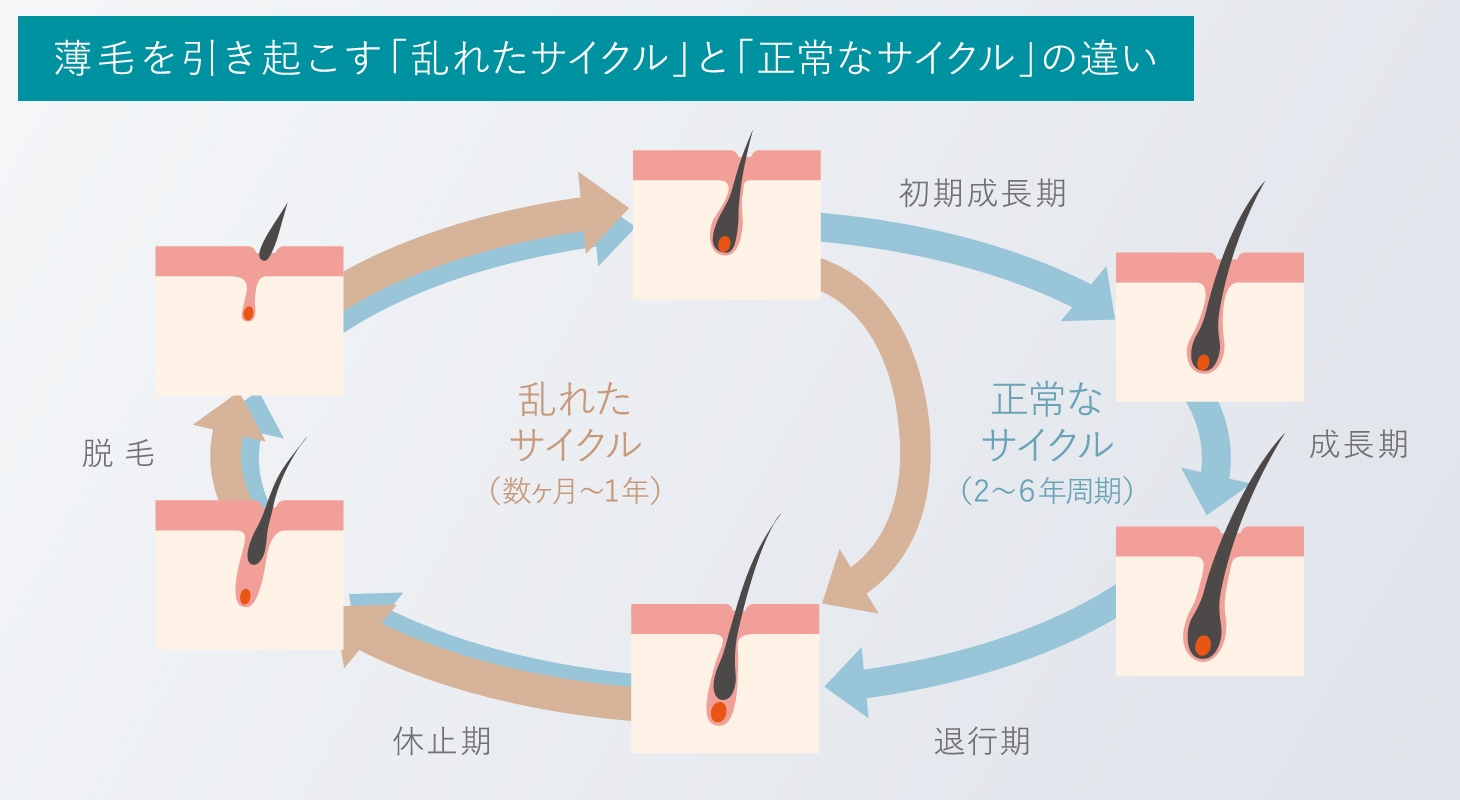 薄毛を引き起こす「乱れたサイクル」と「正常なサイクル」の違い