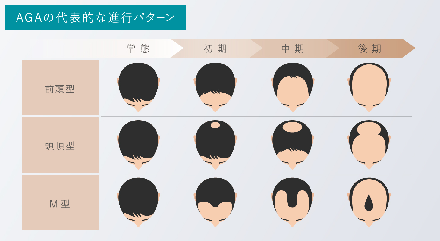 AGAの代表的な進行パターン