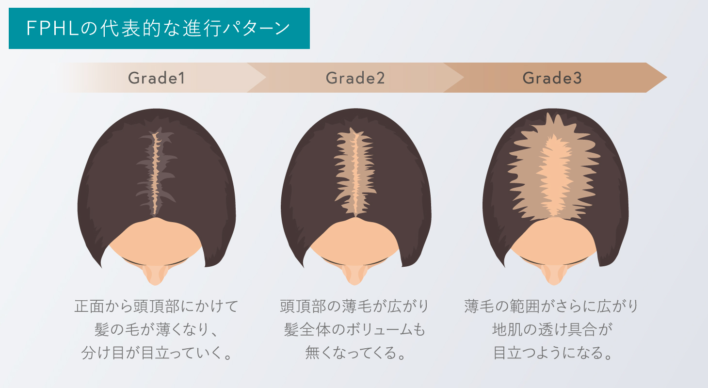 FPHLの代表的な進行パターン